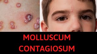 What is Molluscum Contagiosum Symptoms Treatment [upl. by Andersen]