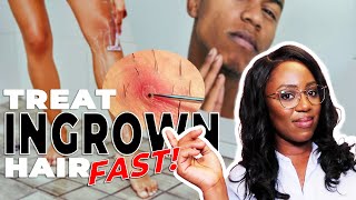 How to Remove Ingrown Hairs and Razor Bumps  This ACTUALLY works [upl. by Ringo]