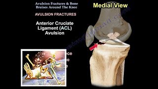 Avulsion Fractures amp Bone Bruises Around The Knee  Everything You Need To Know  Dr Nabil Ebraheim [upl. by Whale]