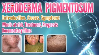 Xeroderma pigmentosum causes symptoms treatment prognosis documentary pronunciation  XP [upl. by Ten]