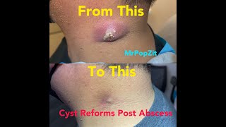 Cyst reforms months after Incision amp Drainage of large neck abscess Removal and dissection today [upl. by Remsen]