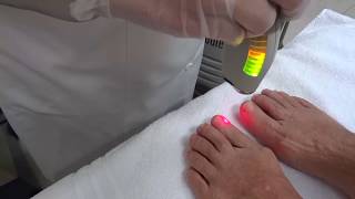 Micose de Unha  Tratamento com laser [upl. by Ahk]