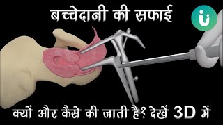 बच्चेदानी की सफाई कब क्यों और कैसे की जाती है 3D में  Dilation and Curettage D amp C in Hindi [upl. by Aiset872]