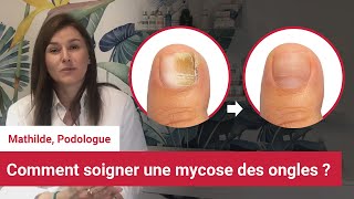 Mycoses des pieds et des ongles  Larme absolue pour sen débarrasser rapidement [upl. by Cho902]