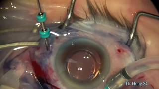 vitrectomy for macular pucker Epiretinal Membrane [upl. by Pahl372]