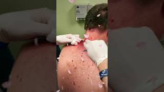 Las Vegas Dermatology Cyst Follow up video 🎥 with incision and drainage procedure 💉 🔪 [upl. by Anaujal]