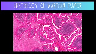 Histology of Warthin Tumor  Dentistry [upl. by Neelloj]