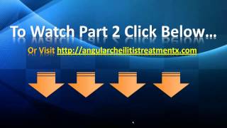 Angular Cheilitis Treatment  Angular Cheilitis Home Remedies [upl. by Dwyer]