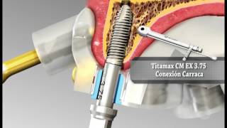 Guía quirúrgica en implantes dentales  Implantes NEODENT [upl. by Douville]