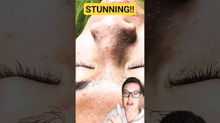 ULTIMATE PORE STRIP REMOVAL  How To Prep Skin For Pore Strips shorts [upl. by Lazes]