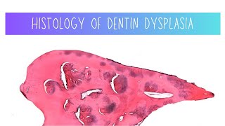 Histology of Dentin dysplasia  Dentistry [upl. by Leonerd]