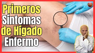 🔴 ¿CUALES SON LOS PRIMEROS SÍNTOMAS DEL HÍGADO ENFERMO E INFLAMADO 🔴 [upl. by Llebana146]