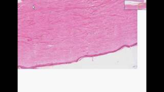 Histopathology Skin kidney Systemic sclerosis scleroderm [upl. by Amice]