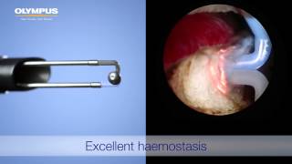 TURis 20  Bipolar Resection [upl. by Dorry963]