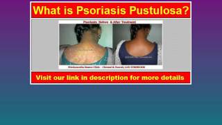 Psoriasis Pustulosa the video for definition of Psoriasis Pustulosa [upl. by Steel]