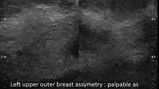 CASE 645 Left upper outer breast fibroglandular tissue assymetry palpable as mass [upl. by Cozmo]