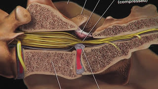 Intervertebral Disc Disease IVDD in Dogs Slipped Discs [upl. by Ocer]