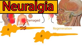 Neuralgia Explained under 3 minutes Trigeminal Neuralgia symptoms and treatment [upl. by Ronica]