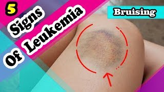 7 Signs and Symptoms You May Have a Leukemia [upl. by Coriss]