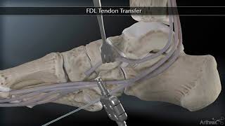 Flexor Digitorum Longus FDL Tendon Transfer [upl. by Aihseyt]