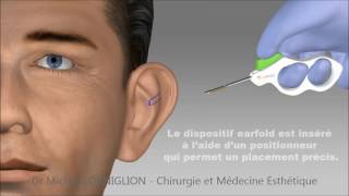 Earfold  une technique non chirurgicale pour les oreilles décollées  Dr Corniglion [upl. by Fauman485]