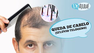 QUEDA DE CABELO EFLÚVIO TELÓGENO O QUE É CAUSAS DIAGNÓSTICO E TRATAMENTO [upl. by Shatzer]