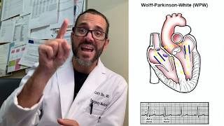 Wolff Parkinson White Syndrome  Patient Education [upl. by Notpmah603]