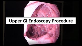 Upper GI Endoscopy Procedure in the ED [upl. by Llerreg]