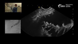 Syndrom der zuführenden Schlinge AfferentLoopSyndrom endoskopische Therapie [upl. by Cynthea246]