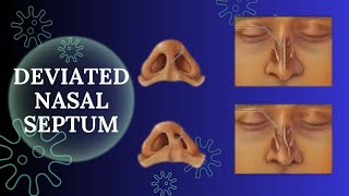 Best Treatment for Deviated Nasal Septum  ناک کی ہڈی ٹیڑھی ہونا  Dr  Tahir Aziz Zafar [upl. by Arst]