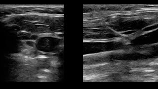 Transvenous Pacemaker Placement by Ultrasound 82020 [upl. by Fremont]