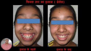 Braces Before and After  Part 4  Orthodontic treatment [upl. by Batory251]