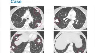 Pulmonary ArterioVenous Malformations [upl. by Nagaek]