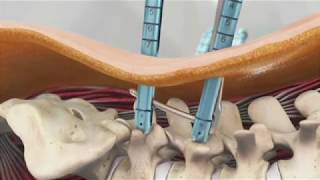 Palisade™ Pedicular Fixation System Animation [upl. by Weaks]