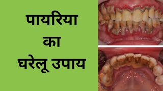 पायरिया का घरेलू उपाय home remedies for pyorrheapyorrhea treatment at homeपायरिया का ईलाज [upl. by Mainis]