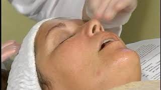 Hypopigmentation Skin Treatments [upl. by Daph881]