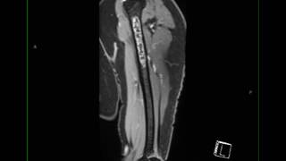 Conventional Chondrosarcoma Humerus [upl. by Bayer]