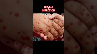 🦠 HPylori Infection Explained 😷 stomach infection shorts [upl. by Baird271]