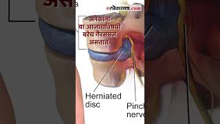 ‘डिस्क’चं आरोग्य कसं बिघडतं जाणून घ्या तज्ज्ञांकडून  Slipped Disc  Health [upl. by Harmonie468]