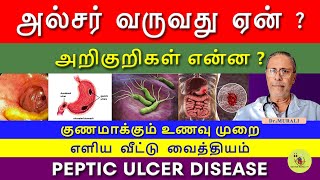 PEPTIC ULCER  SYMPTOMS CAUSES AND TREATMENT IN TAMIL FOODS TO CURE ULCER வயிற்றுப்புண் [upl. by Acnayb]