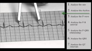 EKG Interpretation and Response SERIES Sinus Dysrhythmias [upl. by Tilford]