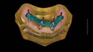 StepbyStep Allon4 Impression Techinique allonX allon4 allon6 fullmouth zygomaticimplants [upl. by Lorrayne]