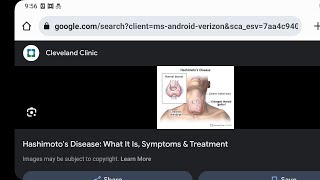 Mystery diagnosis Hashimotos diease and Cushing Syndrome [upl. by Eelta]