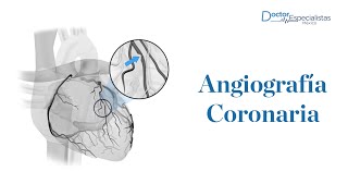 Angiografía coronaria en Guadalajara  Doctores Especialistas [upl. by Truitt535]