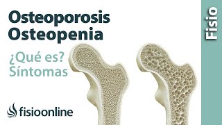 Osteoporosis y osteopenia  Qué es causas síntomas y tratamiento [upl. by Ainav]