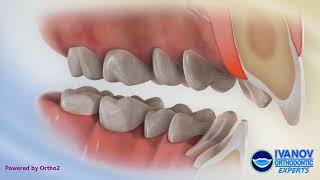 Invisalign Overbite Correction  6 Month UPDATE with before and after pics [upl. by Vita]