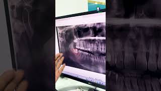 வலிக்காத ஞானப் பல்லையும் எடுத்து விடுங்கள்  Preventive Extraction of Wisdom Tooth  Denta Kings [upl. by Nadean]