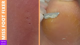 3 CORNS REMOVAL AND CRACKED HEELS TREATMENT BY Miss Foot Fixer [upl. by Eded]