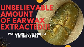 UNBELIEVABLE Amount Of Earwax Extracted From This Ear Watch Until The End [upl. by Laeahcim]