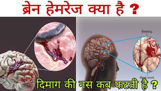 ब्रेन हेमरेज क्या है  दिमाग की नस क्यों और कैसे फटती है  Brain hemorrhage in hindi [upl. by Capon]